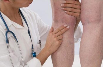 Sintomas da trombose: conheça os principais e saiba como evitar!