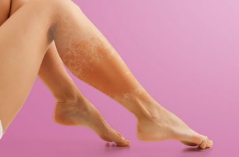 Erisipela: o que é, sintomas, tratamento e prevenção